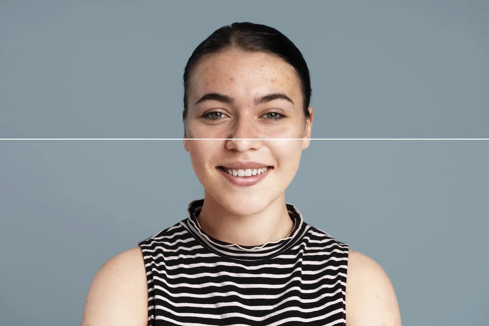 How to Get Rid of Dark Spots and Hyperpigmentation: The Complete Guide